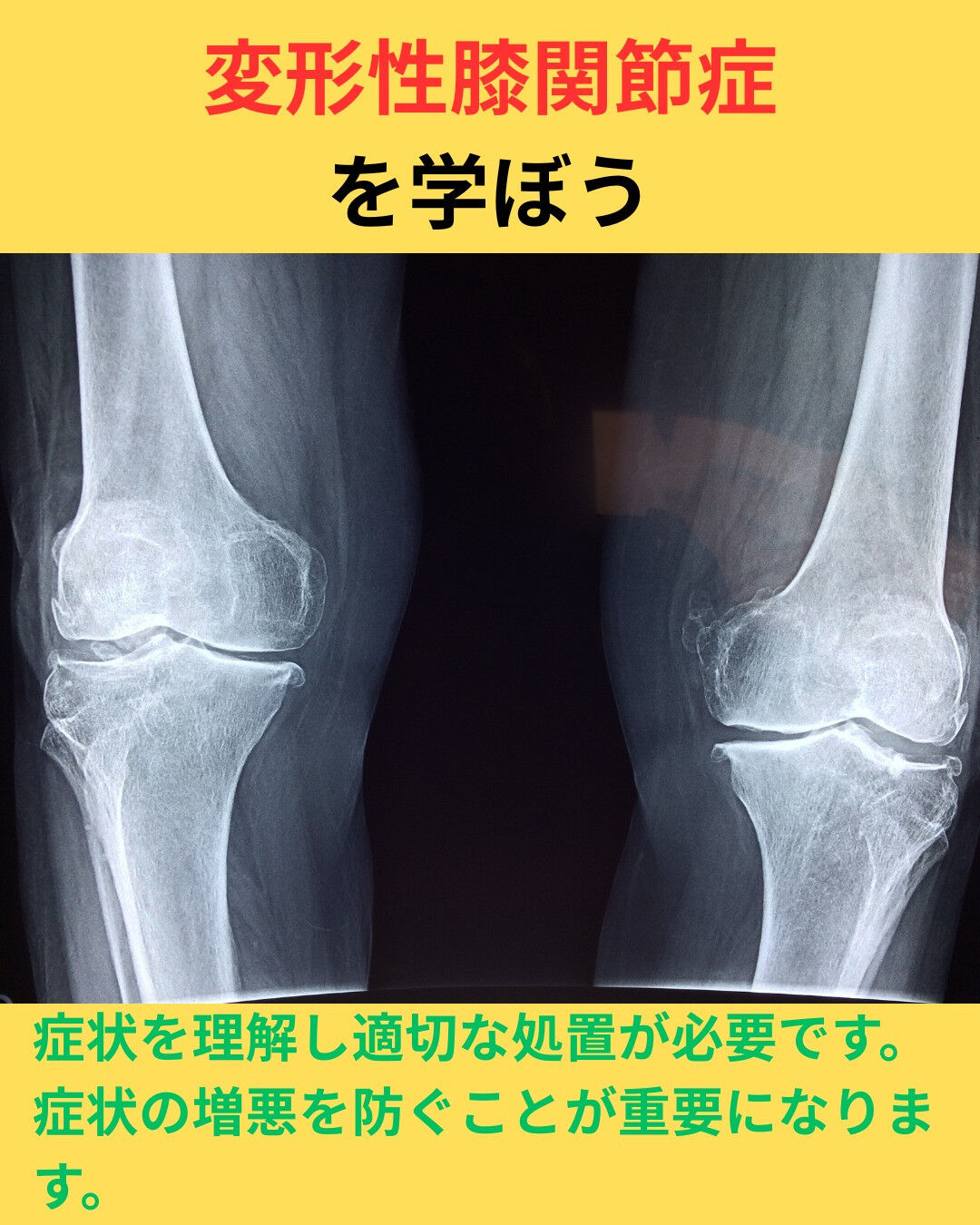 受診したら変形性膝関節症と診断された!?