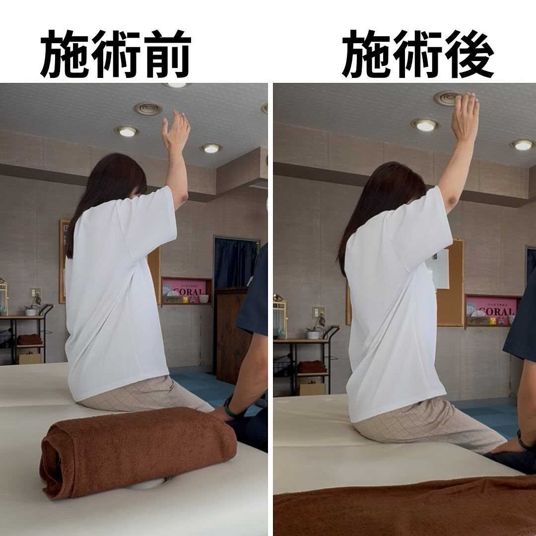 凍結肩　整形外科で授動術を勧められている女性の方