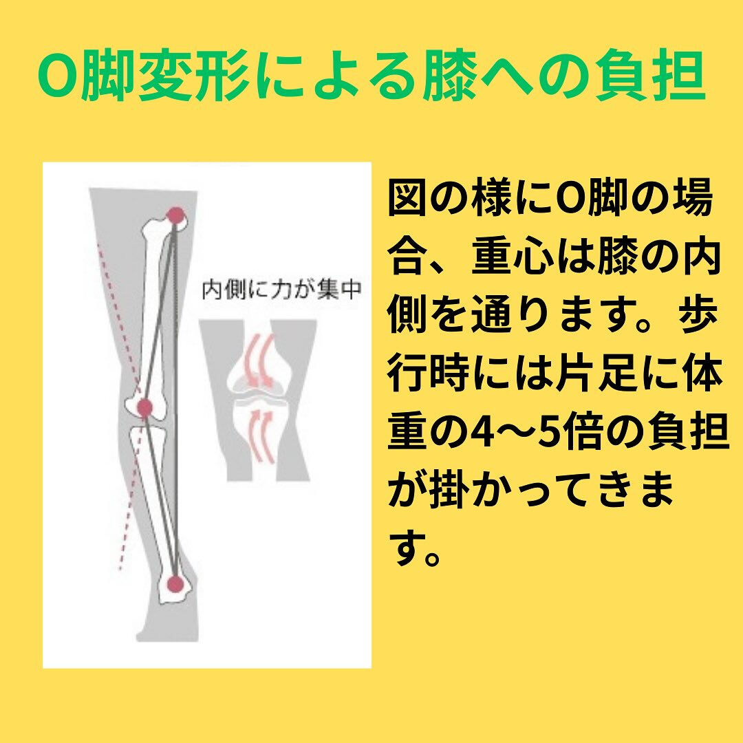 「変形性膝関節症について」