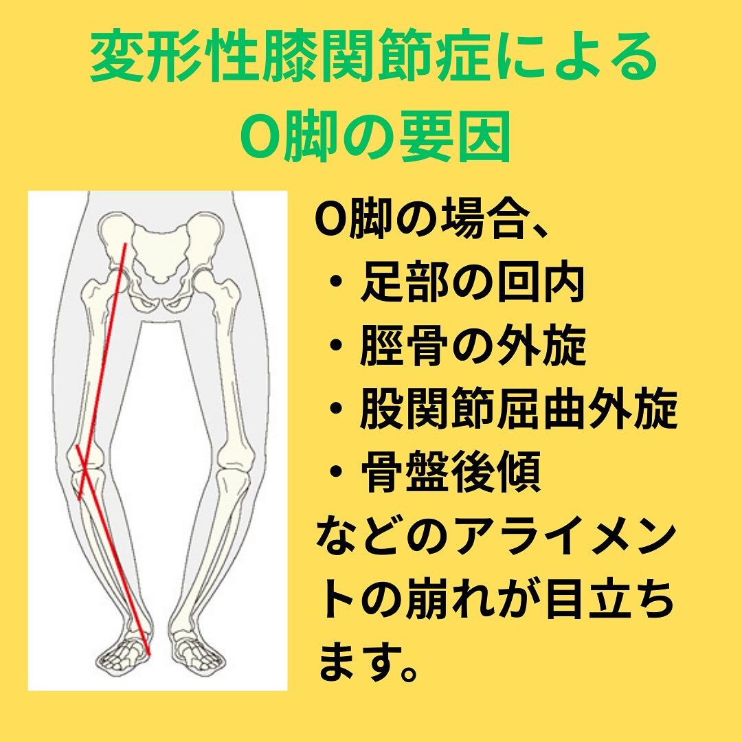「変形性膝関節症について」