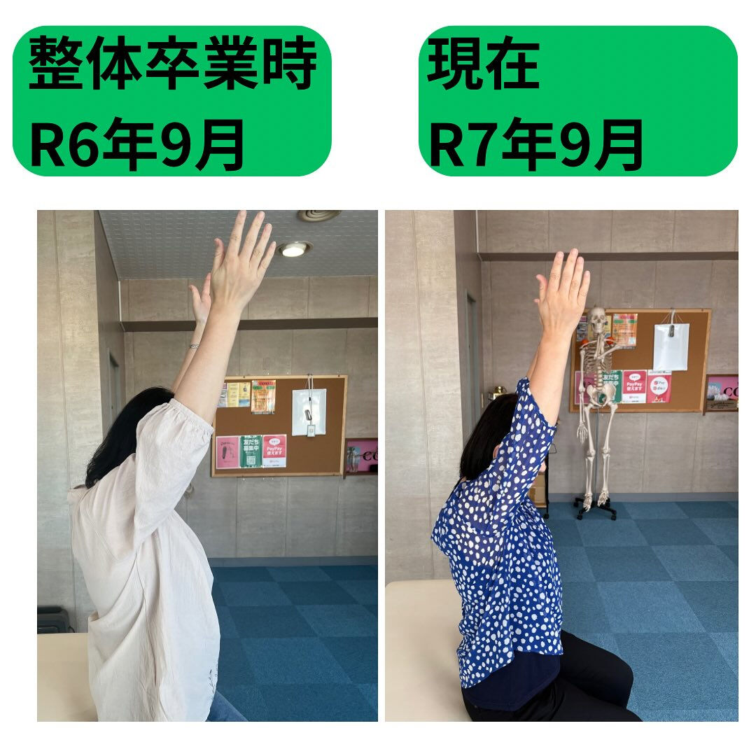 「肩関節周囲炎の整体卒業後の経過」